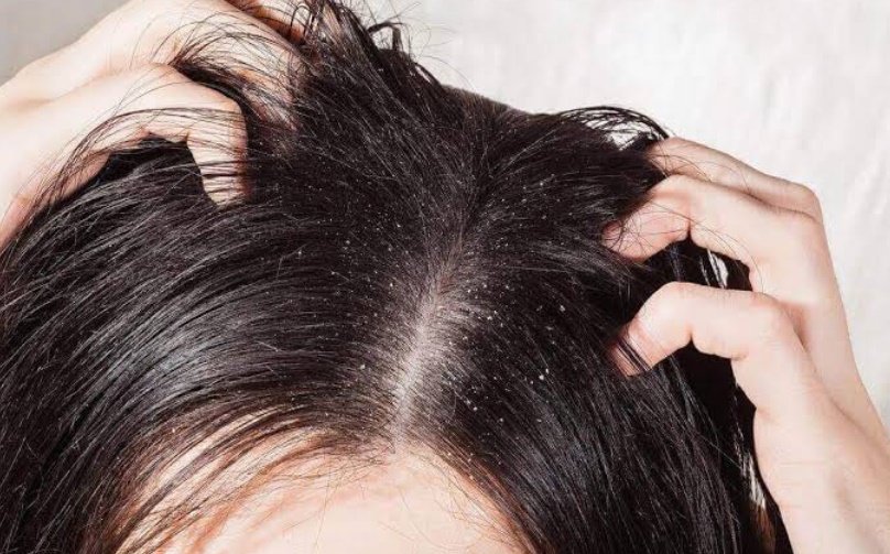 Mantar hastalıkları nedeniyle saç dökülmesi