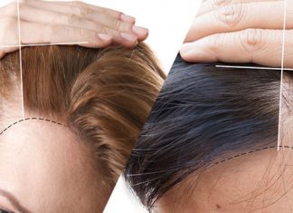 2020 yılı güncel saç ekimi fiyatları ne kadar? 2020 yılı güncel saç ekimi fiyatları ne kadar?