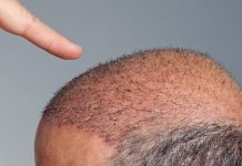 Doğal saç ekimi nasıl yapılır? Doğal saç ekimi nasıl yapılır?