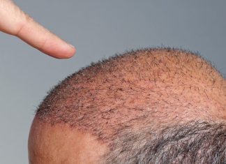 Doğal saç ekimi nasıl yapılır? Doğal saç ekimi nasıl yapılır?