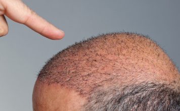 Doğal saç ekimi nasıl yapılır? Doğal saç ekimi nasıl yapılır?