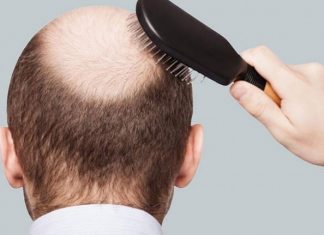 Ekilen saçlar doğal görünür mü? Ekilen saçlar doğal görünür mü?