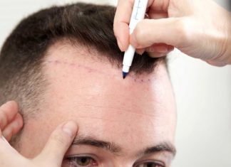 Ekilen saçlar dökülür mü? Ekilen saçlar dökülür mü?