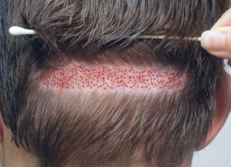 FUE saç ekim yöntemi nedir? FUE saç ekim yöntemi nedir?