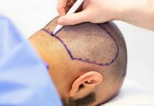 Saç ekim maliyeti ne kadardır? Saç ekim maliyeti ne kadardır?