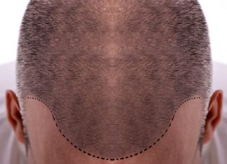 Saç ekimi işlemi ne kadar sürer? Saç ekimi işlemi ne kadar sürer?