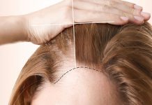 Saç Ekimi kaç gün sürer? Saç Ekimi kaç gün sürer?