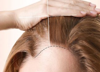 Saç Ekimi kaç gün sürer? Saç Ekimi kaç gün sürer?