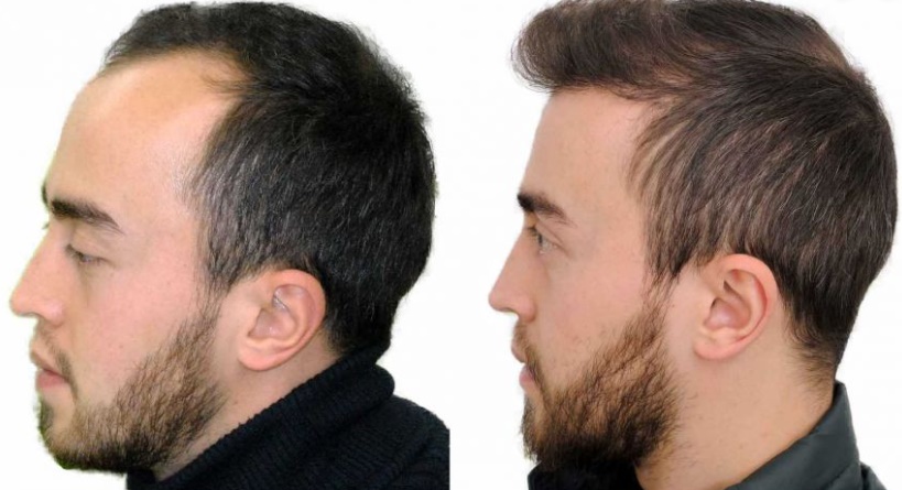 Saç ekimi öncesi ve sonrası resimleri