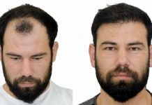 Saç ekimi öncesi ve sonrası resimleri Saç ekimi öncesi ve sonrası resimleri