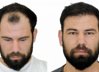 Saç ekimi öncesi ve sonrası resimleri Saç ekimi öncesi ve sonrası resimleri