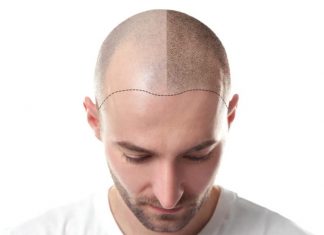 Saç Ekimi Sonrası Dikkat Edilmesi Gerekenler Saç Ekimi Sonrası Dikkat Edilmesi Gerekenler