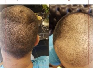 Saç ektirmek caiz mi? Saç ektirmenin günahı var mı? Saç ektirmek caiz mi? Saç ektirmenin günahı var mı?