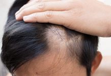 Saçkıran Tipi Saç Dökülmesi Nedir? Saçkıran Tipi Saç Dökülmesi Nedir?