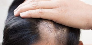 Saçkıran Tipi Saç Dökülmesi Nedir? Saçkıran Tipi Saç Dökülmesi Nedir?