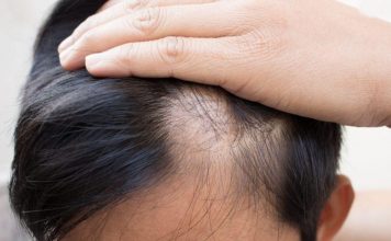 Saçkıran Tipi Saç Dökülmesi Nedir? Saçkıran Tipi Saç Dökülmesi Nedir?